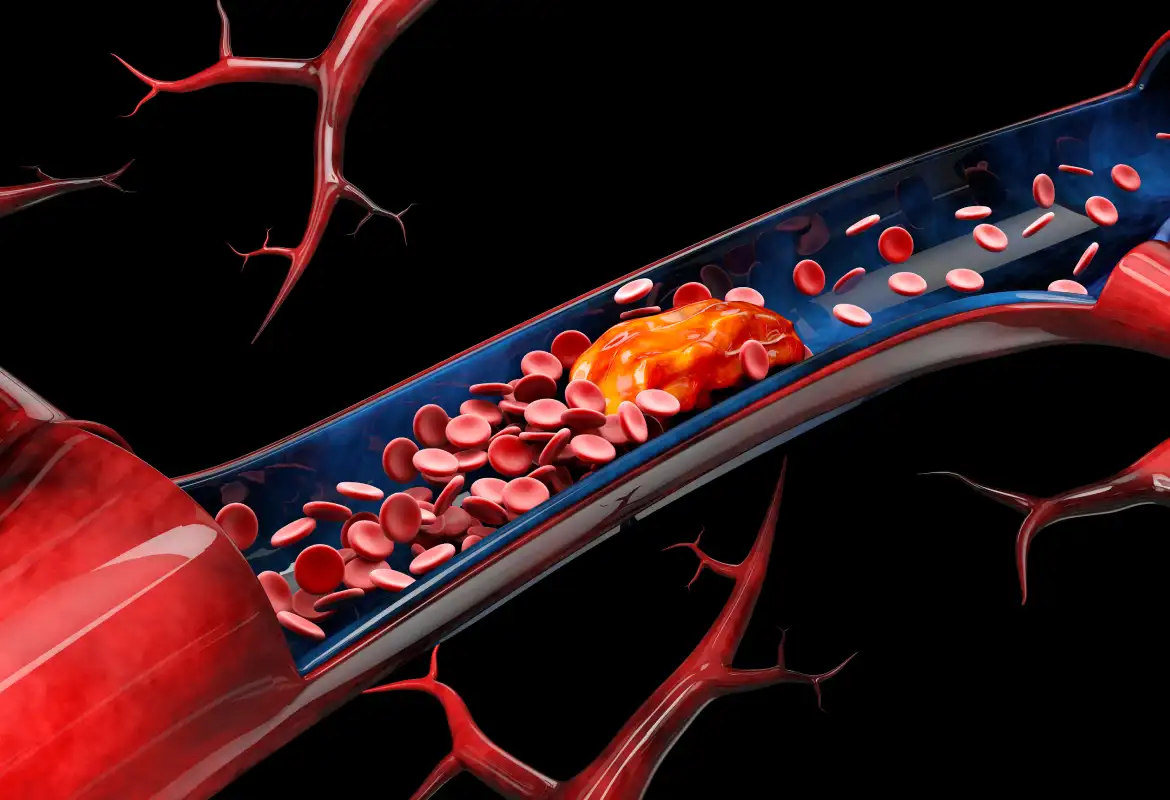 Angioplastia con balón en Monterrey