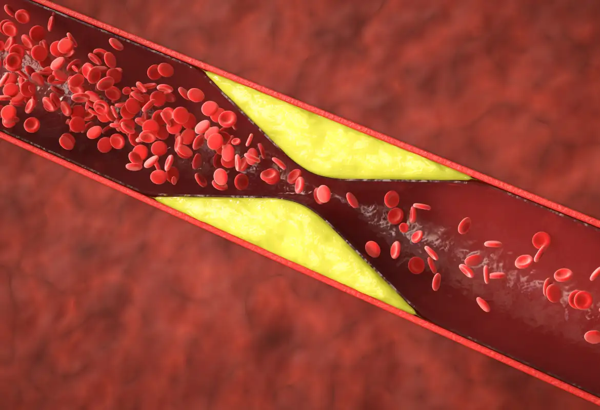 Clínica para angioplastia en Monterrey