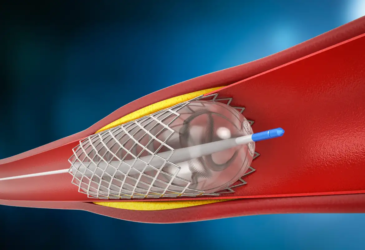 Consulta previa a angioplastia en Monterrey
