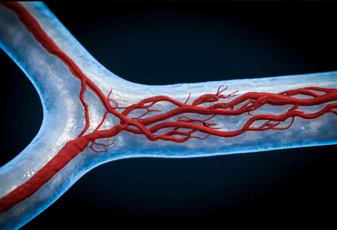 Riesgos de angioplastia en Monterrey