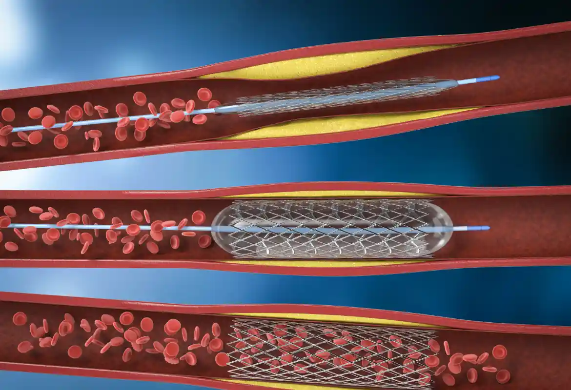 Seguimiento después de angioplastia en Monterrey