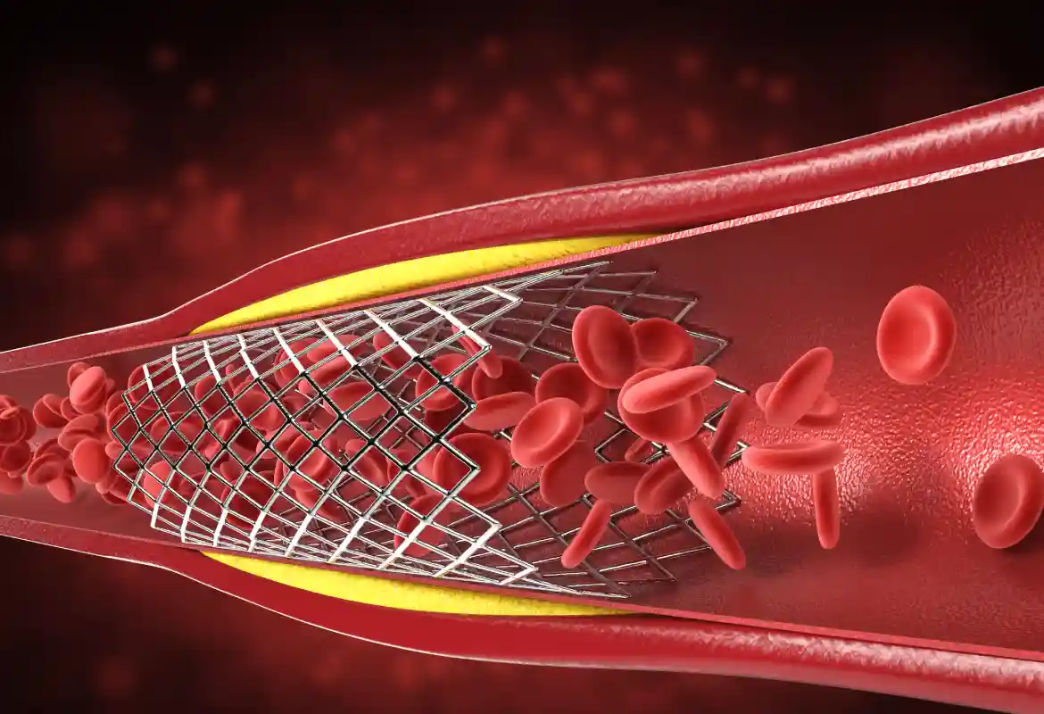 Tratamiento de arterias bloqueadas en Monterrey